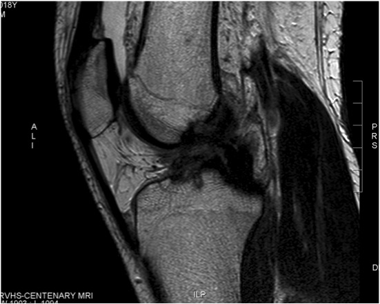 ACL LCL MRI